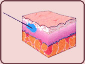 Restylane Einspritzung